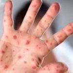 ВОЗДРЖУВАЊЕ ОД ИНТИМНИ ОДНОСИ: ШТО ДРУГО ТРЕБА ДА СЕ НАПРАВИ ВО СЛУЧАЈ НА СОМНЕВАЊЕ НА МАЈМУНСКИ СУПАНИЦИ