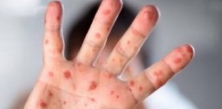 ВОЗДРЖУВАЊЕ ОД ИНТИМНИ ОДНОСИ: ШТО ДРУГО ТРЕБА ДА СЕ НАПРАВИ ВО СЛУЧАЈ НА СОМНЕВАЊЕ НА МАЈМУНСКИ СУПАНИЦИ