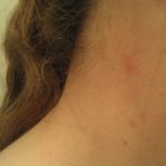 Ви се појавуваат мозолчиња на вратот и по телото? Еве на што ве предупредува вашето тело