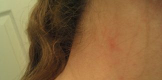 Ви се појавуваат мозолчиња на вратот и по телото? Еве на што ве предупредува вашето тело