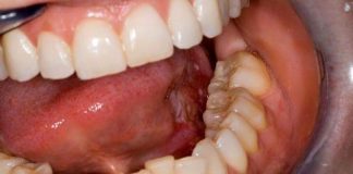 СE Е ИЗЛЕЧИВО ПА И КАРИЕС: ЗАПРЕТЕ со кариес САМИ, без да одите на стоматолог