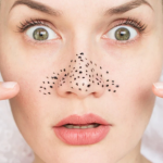 „ЦРНКИТЕ на носот НЕ СЕ митесери“: Д-р Љубица открива како да ја СПРЕЧИТЕ нивната појава