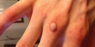КАКО ПРИРОДНО ДА ГИ ОТСТРАНИТЕ БРАДАВИЦИТЕ ВО БИЛО КОЈ ДЕЛ ОД ТЕЛОТО?