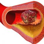 Како се формираат згрутчување на крвта и како се третира тромбозата