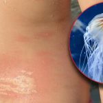 ШТО ДА НАПРАВИТЕ АКО ВЕ НАПАДНЕ МЕДУЗА: Вака изгледа убод од медуза!