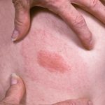 ОВА СЕ ПРВИТЕ ЗНАЦИ ДЕКА ИМАТЕ ЛАЈМСКА-БОЛЕСТ И НЕ СЕ ЧЕШАЈТЕ: Внимавајте многу на ОВОЈ ДЕТАЛ!