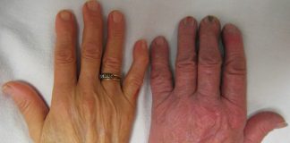 Зголемете го нивото на железо во крвта со овие природни состојки