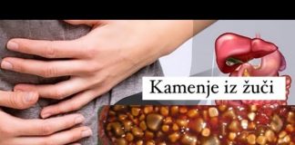 ОВА СЕ СИМПТОМИТЕ КОИ УКАЖУВААТ ДЕКА ИМАТЕ КАМЕН НА ЖОЛЧКАТА: Болка која е тешко да се поднесе!