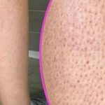 ДАЛИ ОВИЕ ТОЧКИ НА ВАШИТЕ НОЗЕ ВИ ГО РАСИПУВААТ ЛЕТОТО? Еве како да се ослободите од нив, кожата ќе ви биде мазна