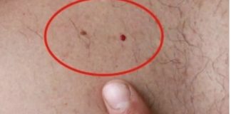Бесплатни дерматолошки прегледи во Градскиот парк по повод борбата против рак на кожа