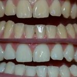 СЕКОЈА ВЕЧЕР СО ОВАА МЕШАВИНА ГИ МАЧКАМ ЗАБИТЕ И СЕ БЕЛИ КАКО БИСЕР: КАРИЕСОТ исчезнаа како однесен со рака, ЕВТИНО РЕШЕНИЕ БЕЗ ОДЕЊЕ КАЈ СТОМАТОЛОГ