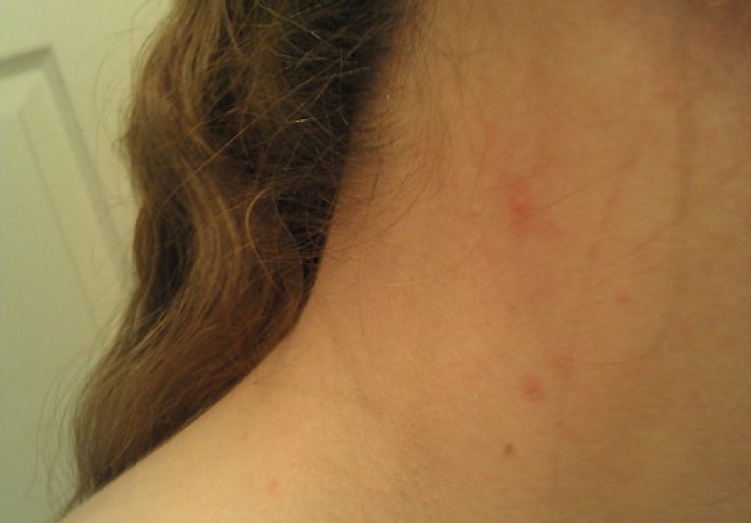 61a51634-ea28-4ddb-b73e-1c9c0a0a0a64-why-am-i-getting-acne-on-my-neck-690x480
