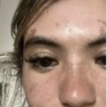 Девојката заспала на плажа, па се погледнала во огледало: Ме болеше и личеше на кеса (ФОТО)