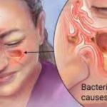 ИЗЛЕЧЕТЕ ИНФЕКЦИЈА НА СИНУСОТ ЗА САМО 20 СЕКУНДИ: Направете го овој домашен пијалок! (РЕЦЕПТ)