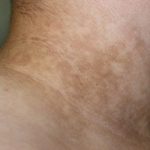 ДАЛИ ЗНАЕТЕ КАКВА БОЛЕСТ Е АКАНТОЗА: Доколку ви се појават вакви дамки на вратот, ВЕДНАШ НА ДОКТОР