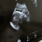 Лекарите им кажале дека нивното неродено дете е мртво, но вистината е сосема поинаква