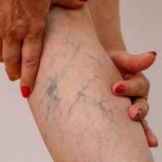 Пробав сè и ништо не ми помогна, со овој рецепт за само три дена ми се повлекоа проширените вени