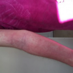 Се избриша со крпа и имаше што да види: По туширањето осипот ѝ се раширил по целото тело