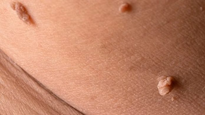 warts-youtube