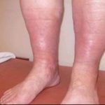 Препознајте ги сигналите на време: Симптоми со кои телото ве предупредува за формирање на згрутчување на крвта