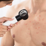 Акни на градите: Што ги предизвикува и што може да направите во домашни услови