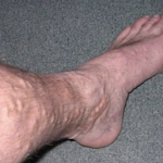 СО ПОМОШ НА ОВАА БИЛКА: Излечете ги проширените вени на сосема природен начин!