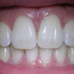 Дали ЧКРИПИТЕ со забите навечер додека спиете? Овие шест знаци ќе ви го откријат тоа!