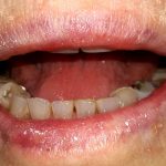 Често ви пукаат усниате и ви опаѓа косата? Еве кој витамин ви недостига