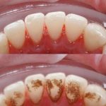 Ослободете се од забен камен, наслаги и бактерии со само една состојка: ОВАА СОСТОЈКА ВЕЌЕ ЈА ИМАТЕ ДОМА