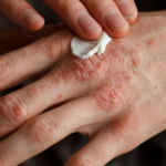 Овa е лек за сите кожни заболувања, вклучително и псоријаза СЕ ПРАВИ МНОГУ ЛЕСНО!