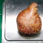 Тежи 800 грама: Не ова не е кромид, туку ГОЛЕМ камен во бубрегот