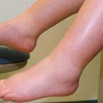 ЕВЕ ЗОШТО НОЗЕТЕ ОТЕКУВААТ НА ТОПЛИНА: Ова е причината и лесно може да се спречи, ЕВЕ ШТО ТРЕБА ДА НАПРАВИТЕ!