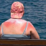 НИТУ ЈОГУРТ НИТУ КИСЕЛО МЛЕКО НЕ ЛЕКУВААТ ОД изгореници, АМА ОВА: Тоа е единствениот СПАС, обрнете внимание