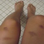 7 ПРИЧИНИ ЗА МОДРИНКИ НА ТЕЛОТО КОИ НЕ СЕ ОД УДАРИ: Еве што би можело да биде!