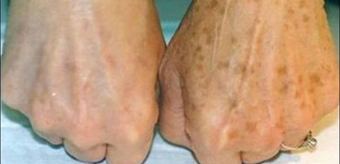 starechki-pegi-kozha-ratse-696x336